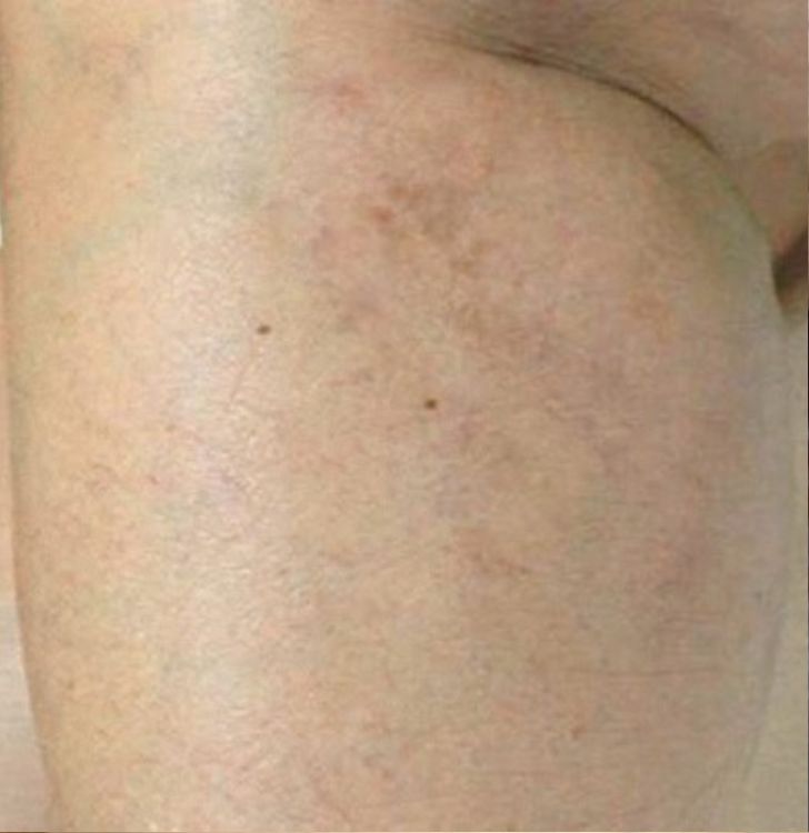 after vein removal 2