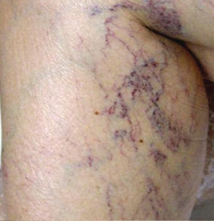 before vein treatment